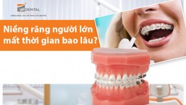 Niềng răng người lớn mất thời gian bao lâu?