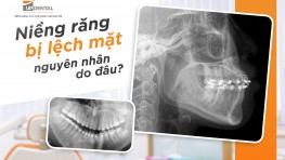 [Giải đáp] Niềng răng bị lệch mặt nguyên nhân do đâu?