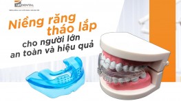 Các phương pháp niềng răng tháo lắp cho người lớn hiện nay