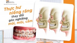 [Thắc mắc] Niềng răng thay đổi góc nghiêng có thật không?