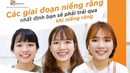 5 giai đoạn niềng răng nhất định bạn sẽ phải trải qua