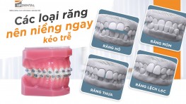 Răng như thế nào thì nên niềng? Cần niềng răng khi nào?