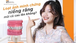 [Giải đáp thắc mắc] Niềng răng mũi có cao lên không? 