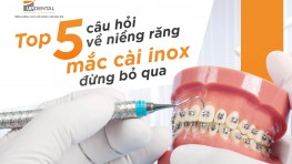 Niềng răng mắc cài inox là gì? 2 loại mắc cài inox hiện nay