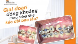 Giai đoạn đóng khoảng trong niềng răng kéo dài bao lâu?