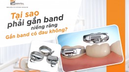 Band niềng răng là gì? Gắn band có đau không?