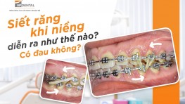 Siết răng khi niềng diễn ra như thế nào? Có đau không?