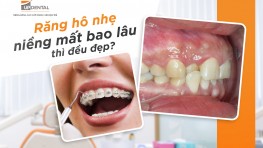 [Giải đáp] Niềng răng hô nhẹ mất bao lâu?