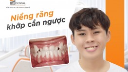 Niềng răng khớp cắn ngược bằng phương pháp nào hiệu quả