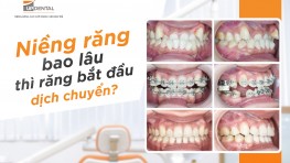 Niềng răng bao lâu thì răng bắt đầu dịch chuyển?