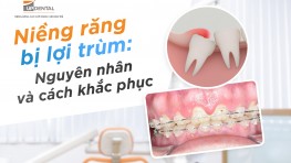 Niềng răng bị lợi trùm - Nguyên nhân và cách khắc phục