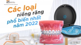 Các loại / các kiểu niềng răng phổ biến nhất năm 2024