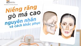 Niềng răng bị gò má cao khắc phục như thế nào?