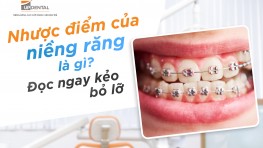  Nhược điểm của niềng răng là gì? Đọc ngay kẻo bỏ lỡ