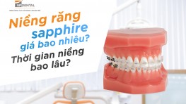 Niềng răng Sapphire giá bao nhiêu? Thời gian niềng bao lâu?