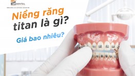 Niềng răng mắc cài Titan là gì? Giá bao nhiêu?