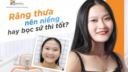 [Giải đáp] Răng thưa nên niềng hay bọc sứ thì tốt?