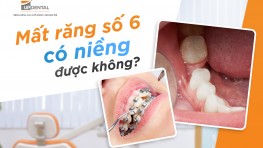 [Giải đáp] Mất răng số 6 có niềng răng được không?