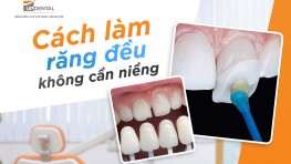 Làm răng đều không cần niềng bằng phương pháp nào