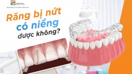 [Giải đáp thắc mắc] Răng bị nứt có niềng được không?