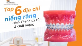 Top 6 địa chỉ niềng răng tại Bình Thạnh uy tín, chất lượng