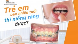 [Thắc mắc] Trẻ mấy tuổi niềng răng được?