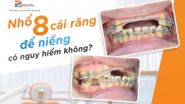 [Giải đáp] Niềng răng nhổ 8 cái răng có nguy hiểm không?