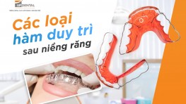 Hàm duy trì niềng răng là gì? Có mấy loại?