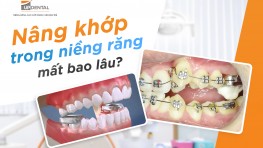 Nâng khớp trong niềng răng là gì? Mất bao lâu?