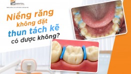 Niềng răng không đặt thun tách kẽ có được không?