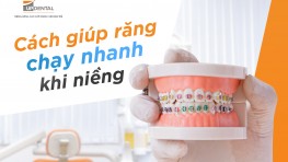 [Thắc mắc] 5 cách giúp răng chạy nhanh khi niềng