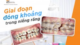 Giai đoạn đóng khoảng trong niềng răng diễn ra thế nào?