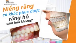 [Giải đáp] Niềng răng có hết cằm lẹm không?