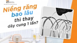 [Giải đáp] Niềng răng bao lâu thì thay dây cung 1 lần