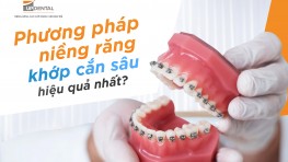 Top 4 phương pháp niềng răng khớp cắn sâu hiệu quả nhất