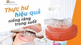 [Giải đáp] Niềng răng trong suốt có hiệu quả không?