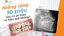 Niềng răng 10 triệu liệu có an toàn và hiệu quả không?