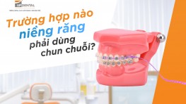Chun chuỗi trong niềng răng là gì? Công dụng và lưu ý