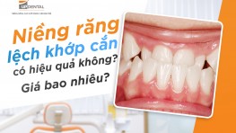 Niềng răng lệch khớp cắn có hiệu quả không? Giá bao nhiêu?