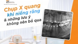 Chụp X quang khi niềng răng và những lưu ý không nên bỏ qua
