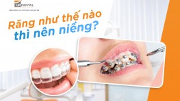 [Giải đáp thắc mắc] Răng như thế nào thì nên niềng?
