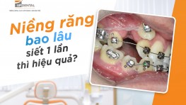  Niềng răng bao lâu siết 1 lần thì hiệu quả?
