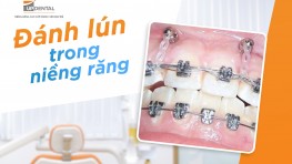 Đánh lún trong niềng răng là gì, khi nào cần đánh lún