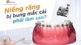 [Thắc mắc] Niềng răng bị bung mắc cài xử lý thế nào?