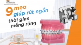 9 mẹo giúp rút ngắn thời gian niềng răng