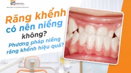 Răng khểnh có nên niềng không, phương pháp niềng khểnh hiệu quả?