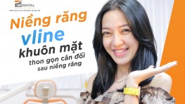 Niềng răng vline, khuôn mặt thon gọn cân đối sau niềng răng