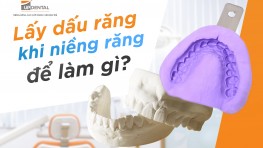 [Thắc mắc] Lấy dấu răng khi niềng để làm gì?