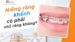 Niềng răng khểnh có phải nhổ răng không?