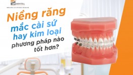 Nên chọn phương pháp niềng răng mắc cài sứ hay kim loại